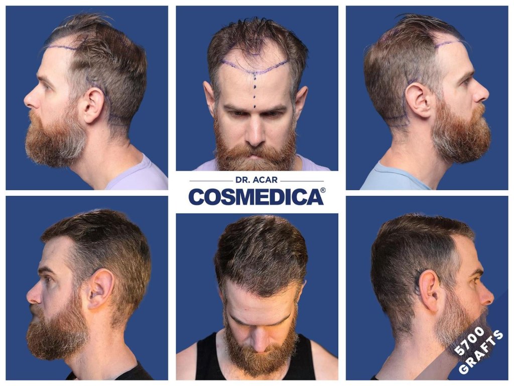 Turkey Hair Transplant Cost in 2026